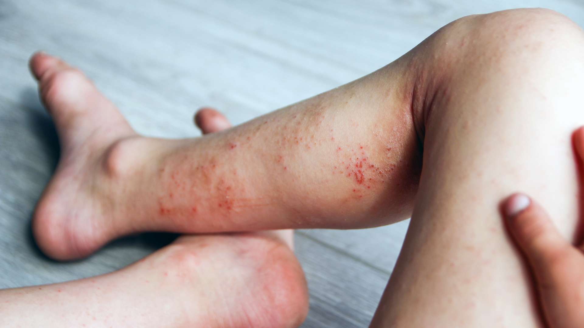 Skin Infections and Irritations
