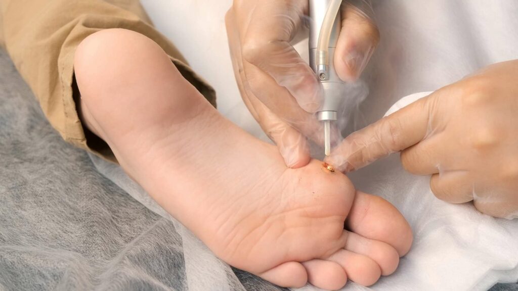 wart removal